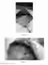 Fig. 06 - SURGICAL RETRACTOR DEVICE TO PROTECT UNDERLYING TISSUE
