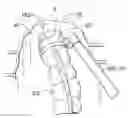 Fig. 01 - Surgical string applicator for anastomosis surgery
