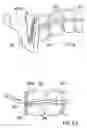 Fig. 06 - Surgical string applicator for anastomosis surgery