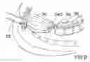 Fig. 09 - Surgical string applicator for anastomosis surgery