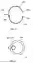 Fig. 22 - Surgical string applicator for anastomosis surgery