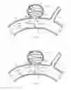 Fig. 07 - System for and method of treating aneurysms