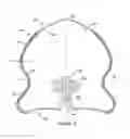 Fig. 04 - Occlusive medical device with delivery system