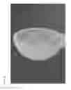 Fig. 07 - METHODS AND POLYMER COMPOSITIONS FOR TREATING RETINAL DETACHMENT AND OTHER OCULAR DISORDERS