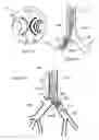 Fig. 02 - Endobronchial tube with integrated image sensor