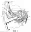 Fig. 02 - Full postoperative insertion of partially inserted cochlear implants
