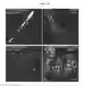 Fig. 09 - Intrathecal delivery of nucleic acid sequences encoding ABCD1 for treatment of adrenomyeloneuropathy