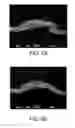 Fig. 07 - Smooth and bulky tissue