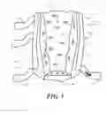 Fig. 02 - Heel protector and corresponding rehabilitation systems and methods for using the same