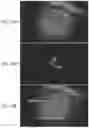 Fig. 32 - Method of detecting diseased or damaged tissue with a pH-triggered polypeptide fluorophore composition
