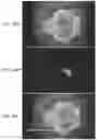 Fig. 33 - Method of detecting diseased or damaged tissue with a pH-triggered polypeptide fluorophore composition
