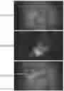 Fig. 40 - Method of detecting diseased or damaged tissue with a pH-triggered polypeptide fluorophore composition