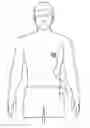 Fig. 01 - Early warning of LVAD thrombus formation