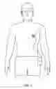 Fig. 02 - Early warning of LVAD thrombus formation