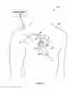 Fig. 02 - Helical fixation member assembly having bi-directional controlled drug release