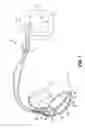Fig. 04 - Helical fixation member assembly having bi-directional controlled drug release