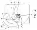 Fig. 22 - Earpiece positioning and retaining