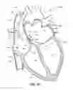Fig. 12 - Systems and methods to determine HR, RR and classify cardiac rhythms based on atrial IEGM and atrial pressure signals
