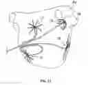 Fig. 28 - Catheter with staggered electrodes spine assembly