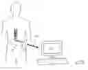 Fig. 01 - Neural stimulation for reduced artefact
