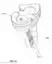 Fig. 16 - Retrograde resection apparatus and method
