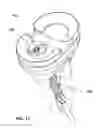 Fig. 17 - Retrograde resection apparatus and method
