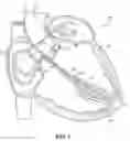 Fig. 02 - Devices and methods for a totally percutaneous collapsible aortic punch