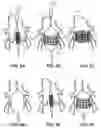 Fig. 03 - Devices and methods for a totally percutaneous collapsible aortic punch