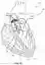 Fig. 08 - Devices and methods for a totally percutaneous collapsible aortic punch