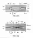 Fig. 34 - Clot retrieval system
