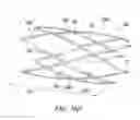 Fig. 37 - Clot retrieval system