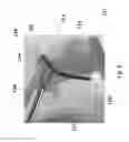 Fig. 06 - Surgical cannula and methods of use