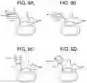 Fig. 06 - Methods for correction of spinal deformities