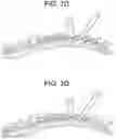 Fig. 08 - Methods for correction of spinal deformities