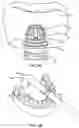 Fig. 13 - Removable and adjustable abutment devices and methods of operation thereof
