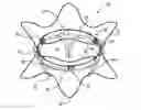 Fig. 01 - Rotation-based anchoring of an implant