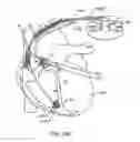 Fig. 75 - Flat-through capacitor mounted in a tombstone position on a hermetic feedthrough for an active implantable medical device