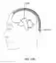 Fig. 76 - Flat-through capacitor mounted in a tombstone position on a hermetic feedthrough for an active implantable medical device