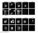 Fig. 01 - Capture, identification and use of a new biomarker of solid tumors in body fluids