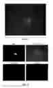 Fig. 06 - Capture, identification and use of a new biomarker of solid tumors in body fluids