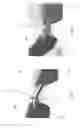Fig. 06 - Flexible bridge assembly for rimless eyewear