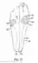 Fig. 12 - Anatomical support method using elongate strap support