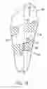 Fig. 17 - Anatomical support method using elongate strap support