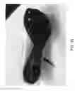 Fig. 17 - Sole structure for article of footwear