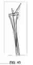 Fig. 35 - Bone reconstruction and orthopedic implants