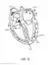 Fig. 14 - Apparatus and method for catheter navigation using endovascular energy mapping