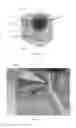 Fig. 03 - Detection of tissue damage