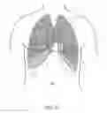 Fig. 07 - Medical device with acoustic sensor