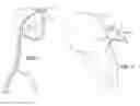 Fig. 02 - Assembly and Device for Left Atrial Appendage Occlusion