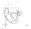 Fig. 02 - Occlusive medical device